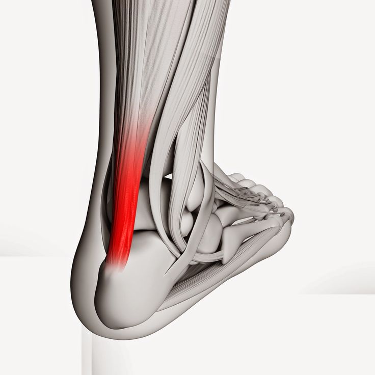 Achilles Tendinitis